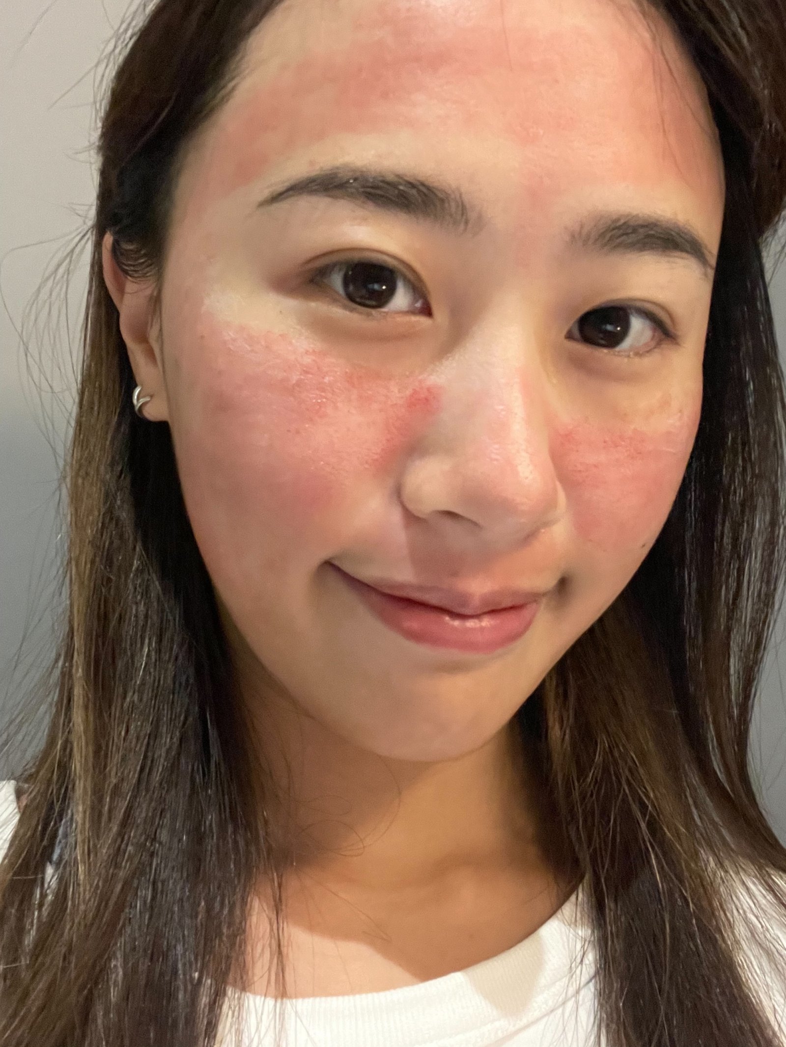 新竹皮秒雷射推薦