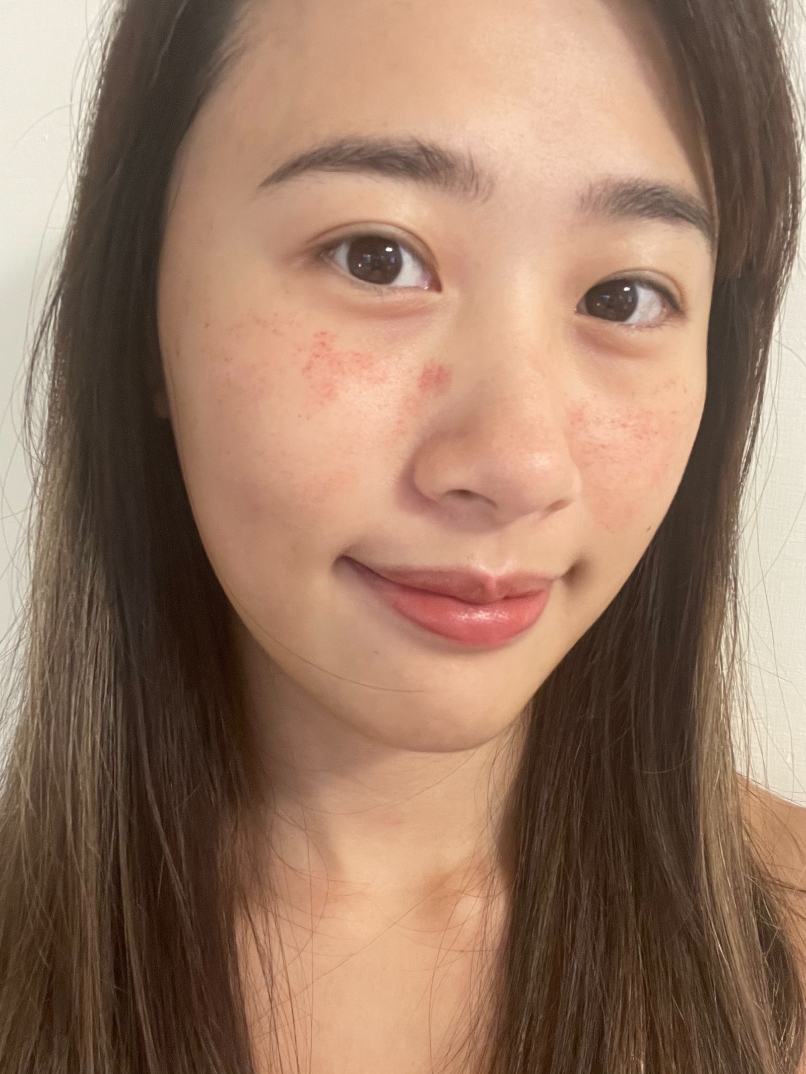 新竹皮秒雷射推薦